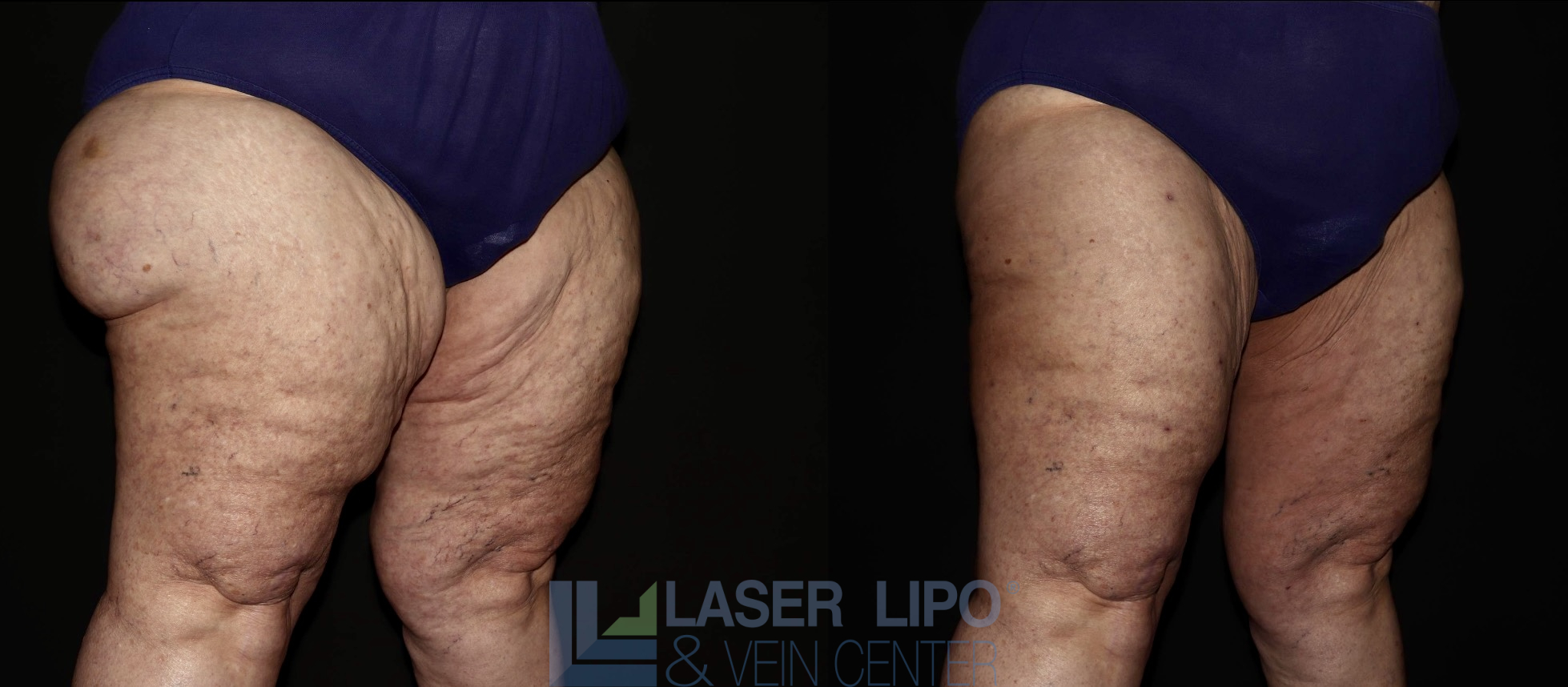 Before and After Image: Lipedema – Thighs - right-front-oblique