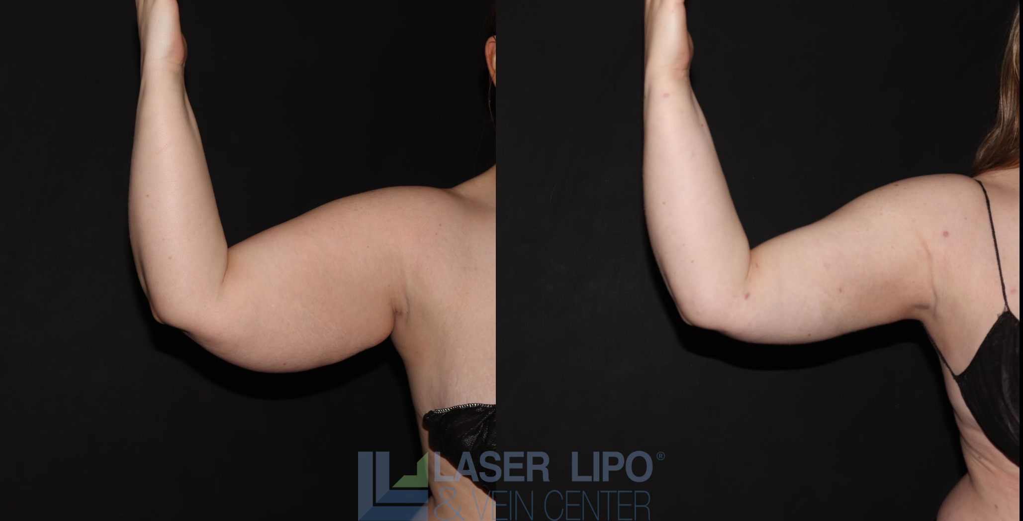 Before and After Image: Stage 2 – Arms - front