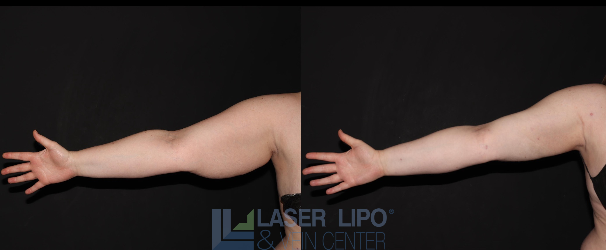Before and After Image: Stage 2 – Arms - front
