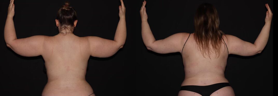 Before and After Image: Stage 2 – Arms - back