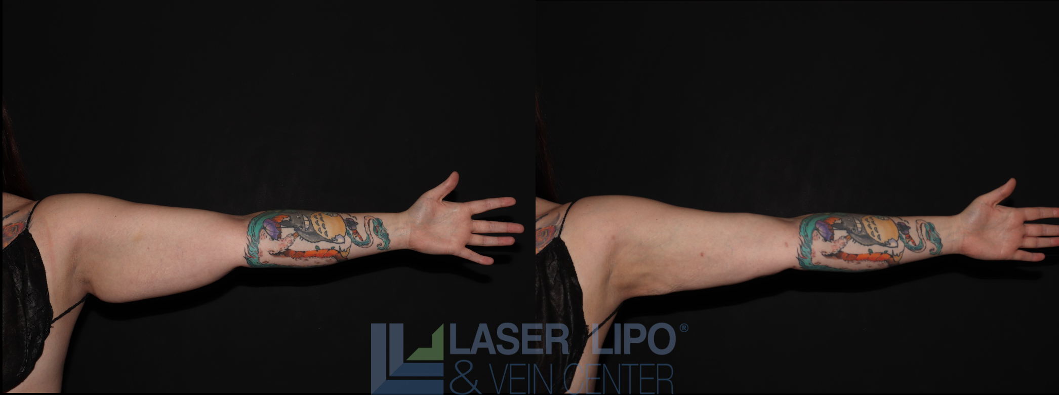 Before and After Image: Stage 2 – Arms - front