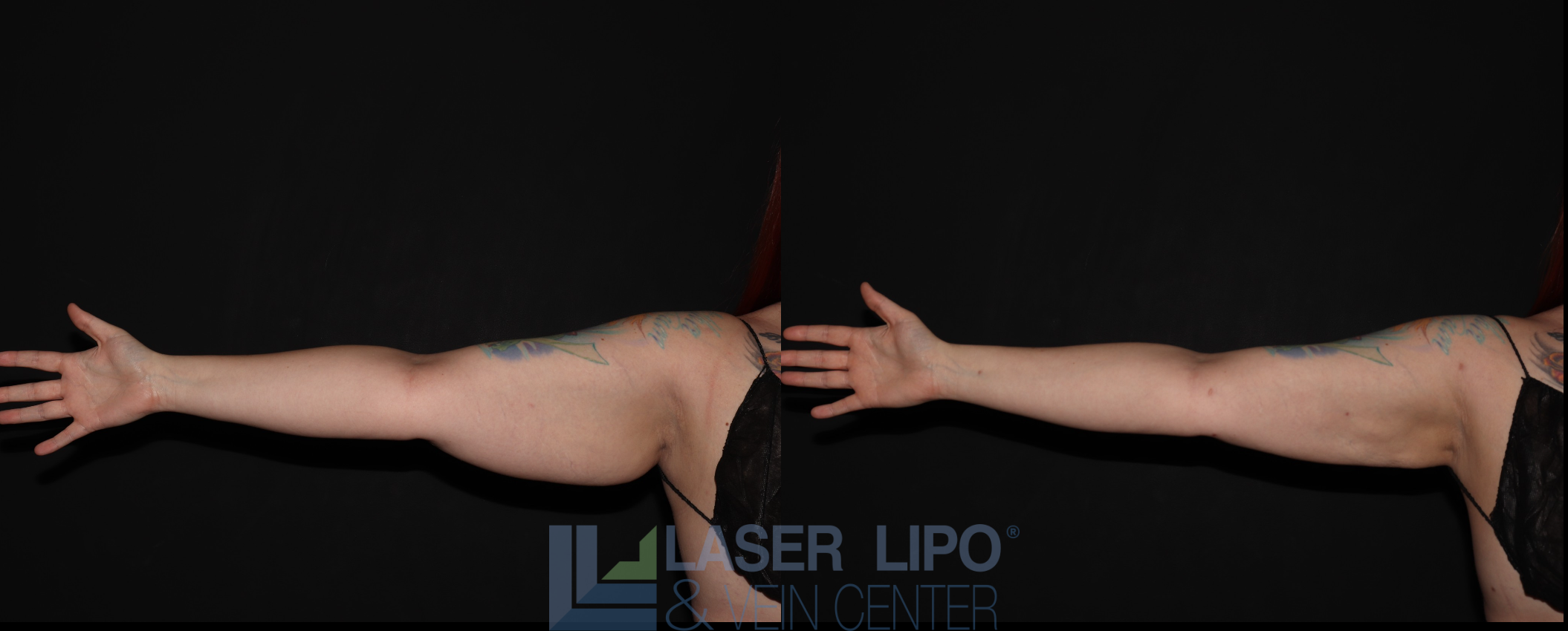 Before and After Image: Stage 2 – Arms - front