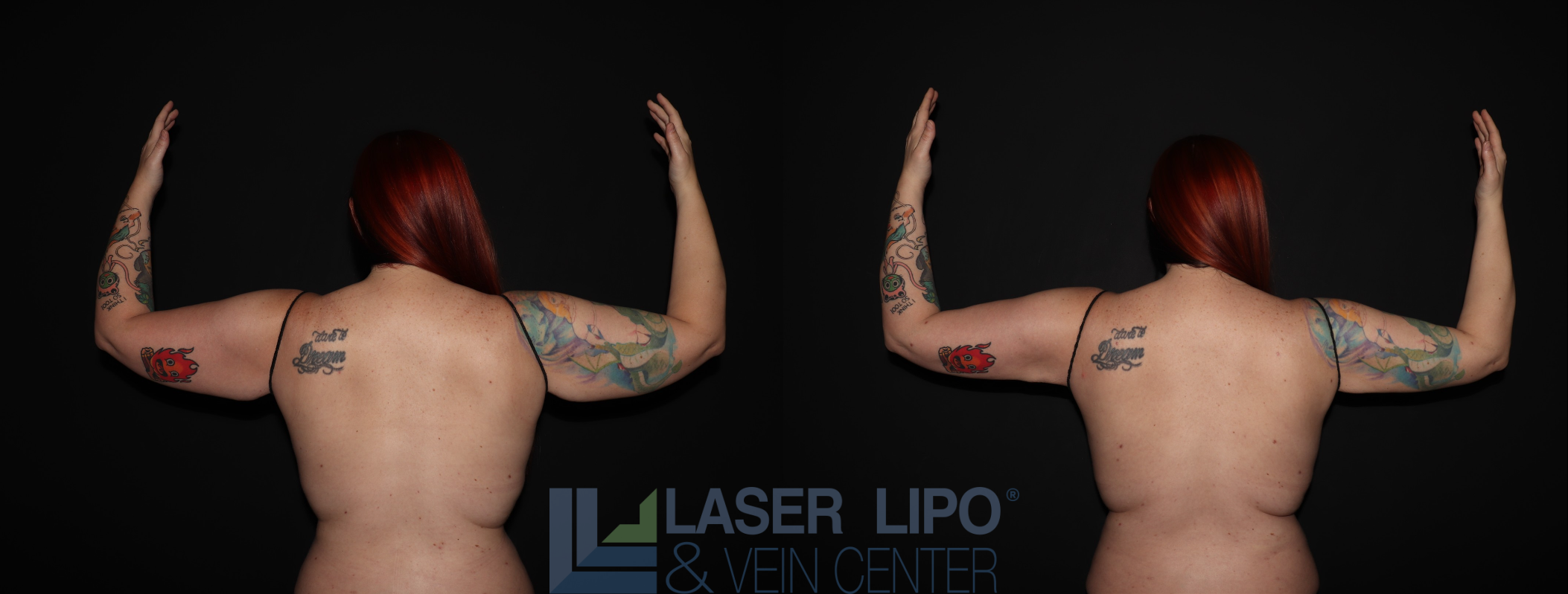 Before and After Image: Stage 2 – Arms - back