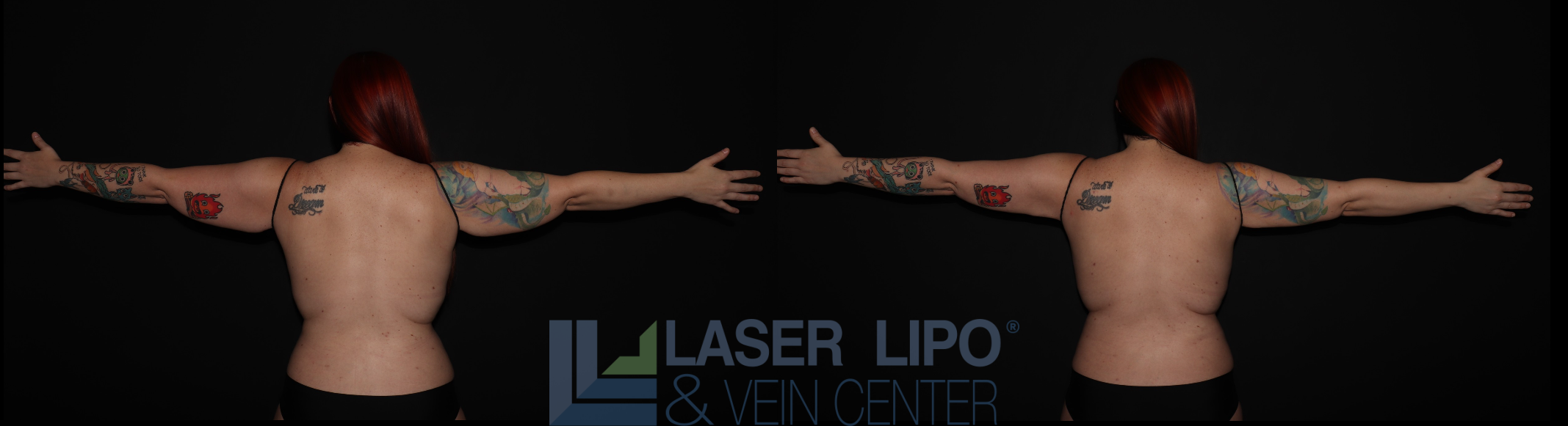 Before and After Image: Stage 2 – Arms - back