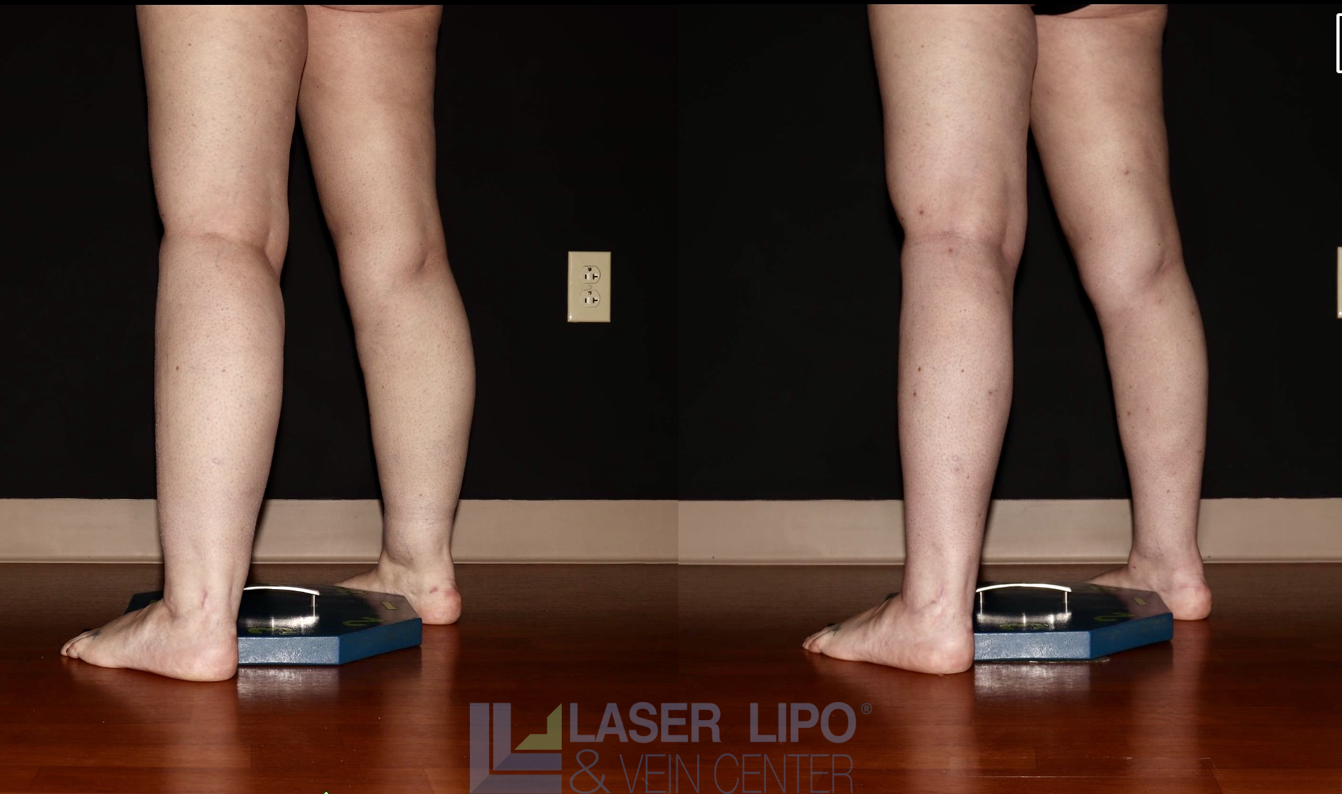 Before and After Image: Stage 2 – Calves - left-back-oblique