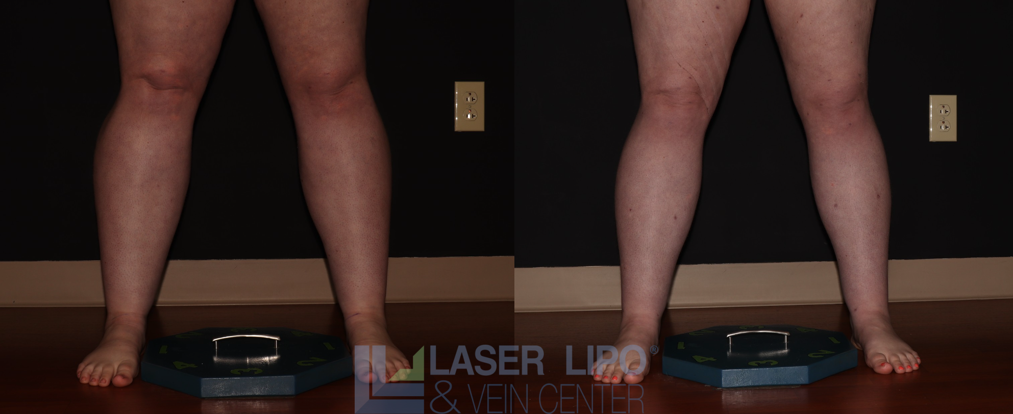 Before and After Image: Stage 2 – Calves - front