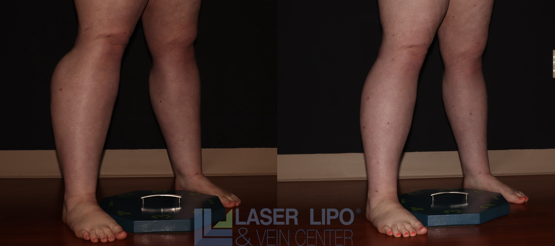 Before and After Image: Stage 2 – Calves - right-front-oblique