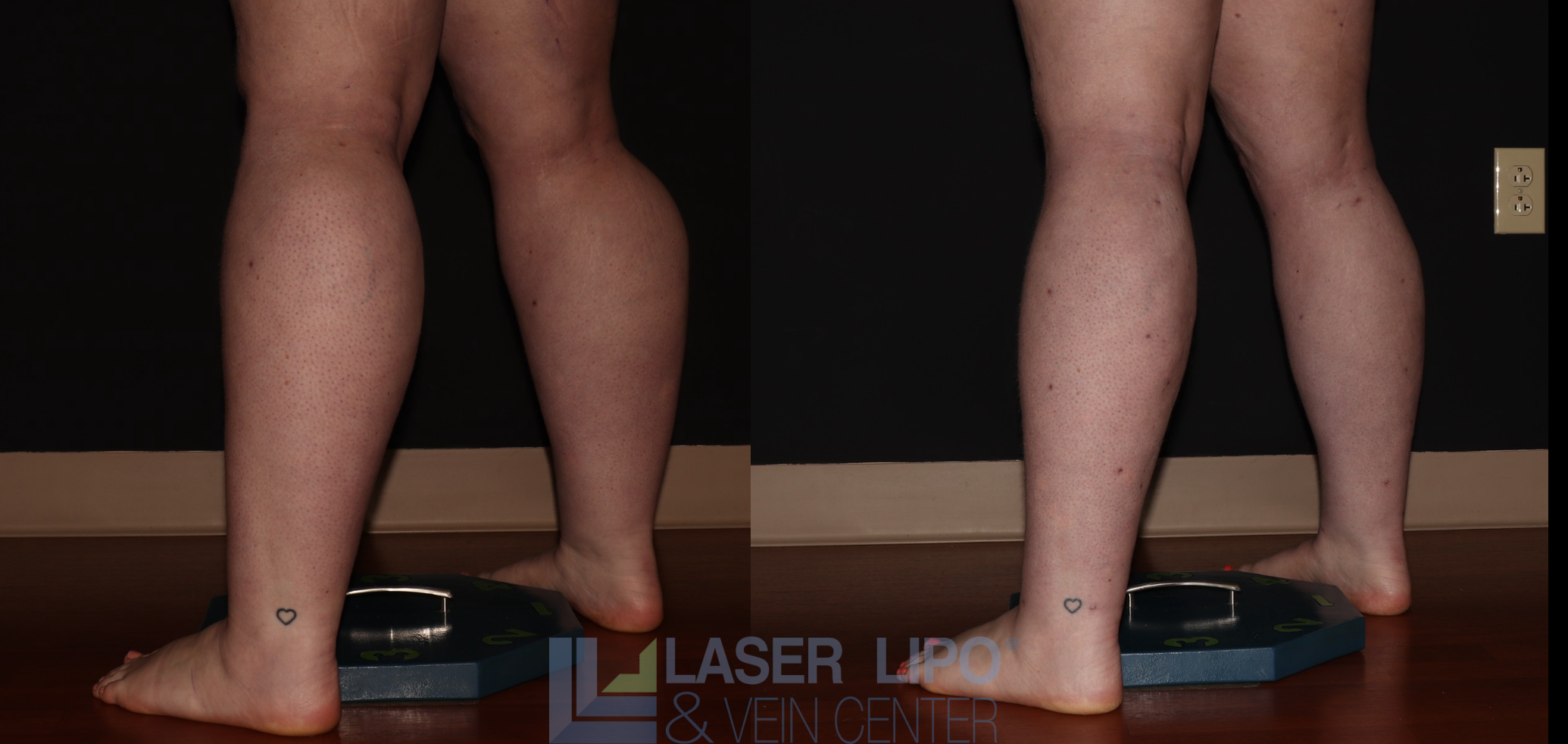 Before and After Image: Stage 2 – Calves - left-back-oblique