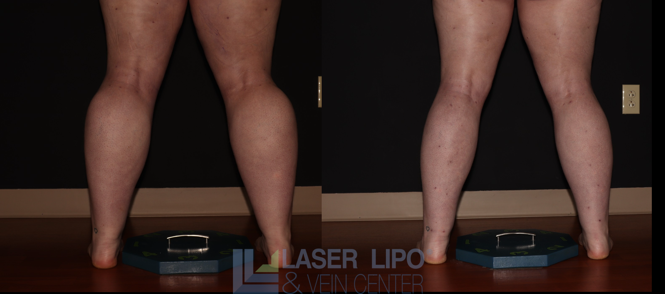 Before and After Image: Stage 2 – Calves - back
