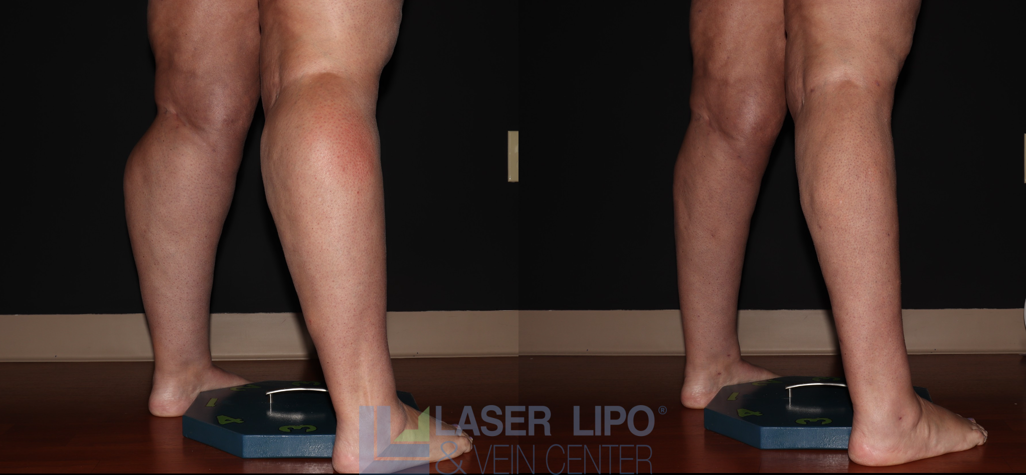 Before and After Image: Stage 2 – Calves - right-back-oblique