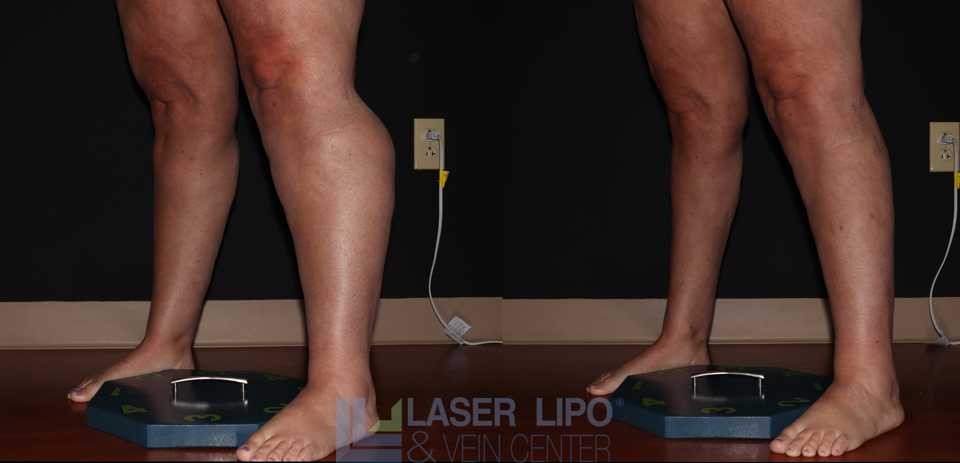 Before and After Image: Stage 2 – Calves - left-front-oblique