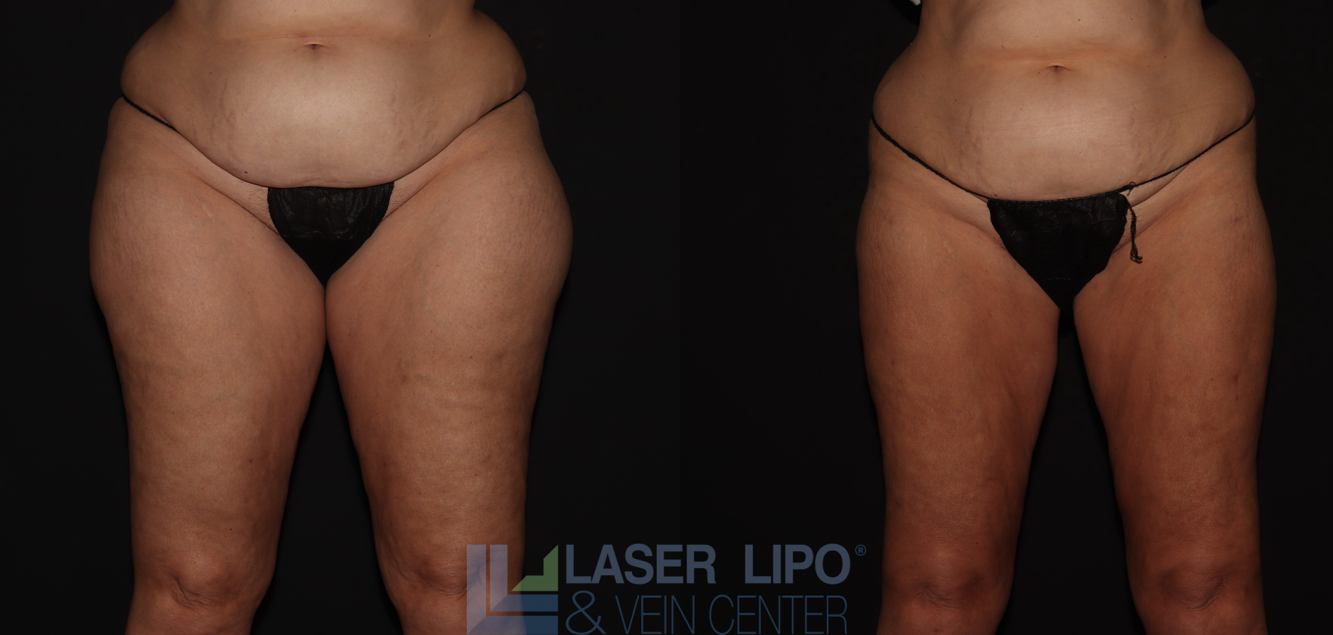 Before and After Image: Stage 2 – Thighs-Buttocks - front