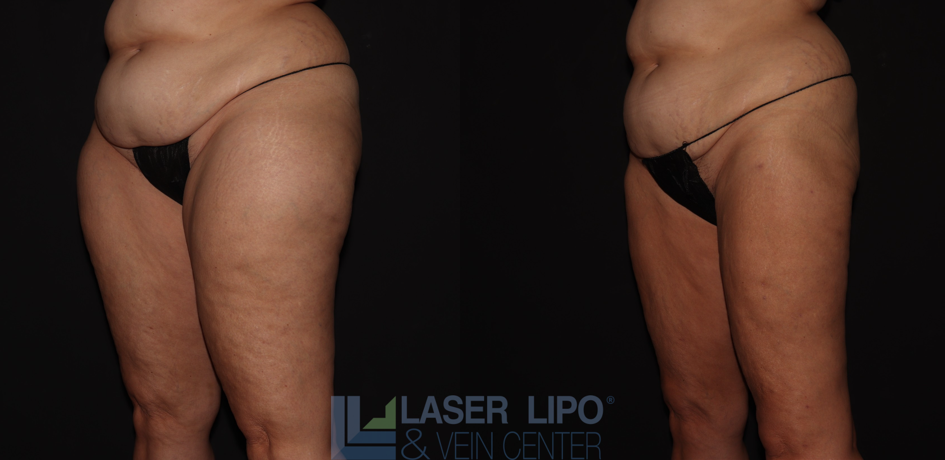 Before and After Image: Stage 2 – Thighs-Buttocks - left-front-oblique
