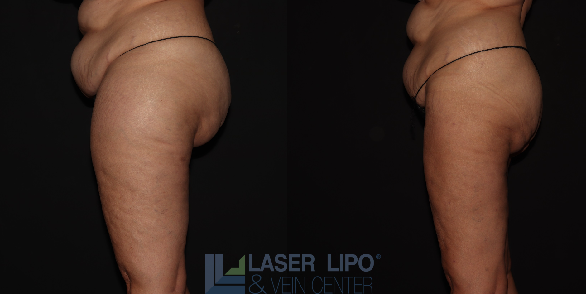 Before and After Image: Stage 2 – Thighs-Buttocks - left-side