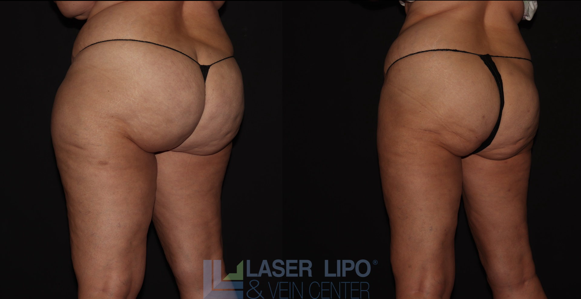Before and After Image: Stage 2 – Thighs-Buttocks - left-back-oblique