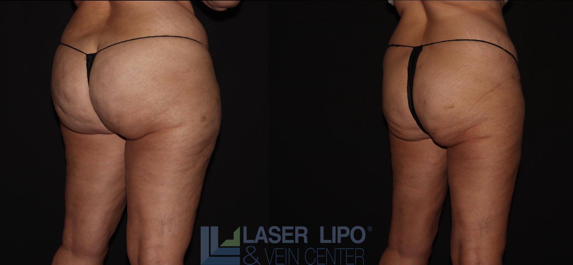 Before and After Image: Stage 2 – Thighs-Buttocks - right-back-oblique