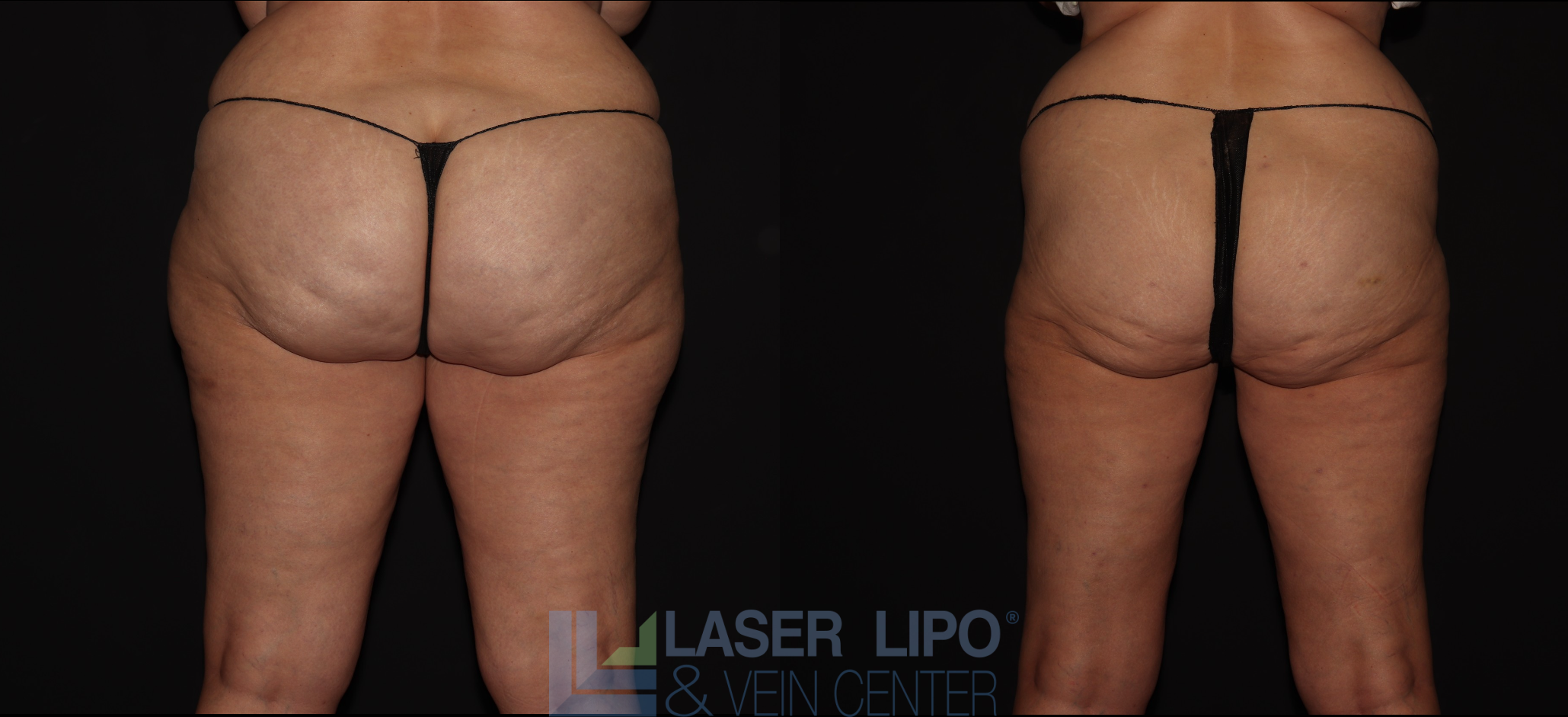 Before and After Image: Stage 2 – Thighs-Buttocks - back