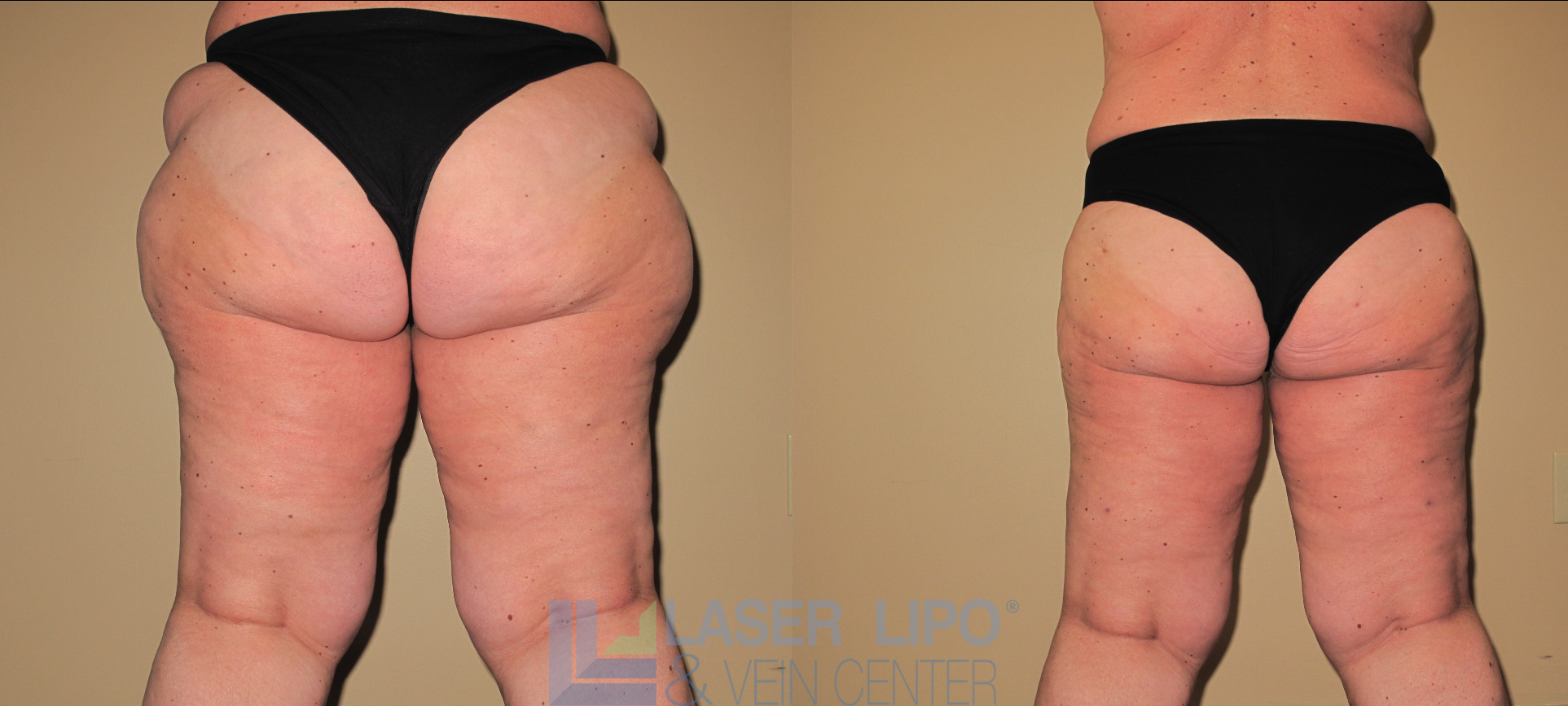 Before and After Image: Stage 2 – Thighs-Buttocks - back