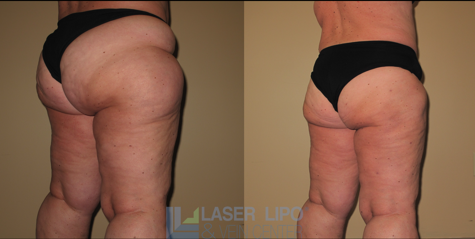 Before and After Image: Stage 2 – Thighs-Buttocks - right-back-oblique