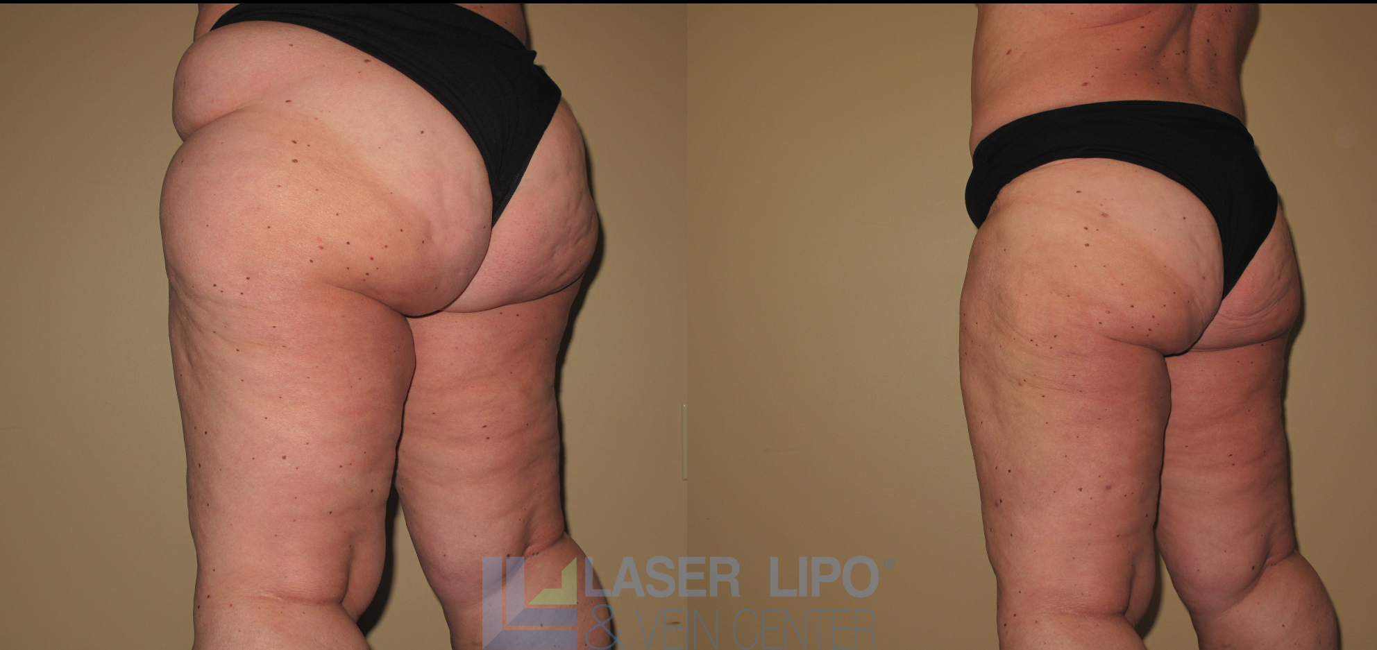 Before and After Image: Stage 2 – Thighs-Buttocks - left-back-oblique