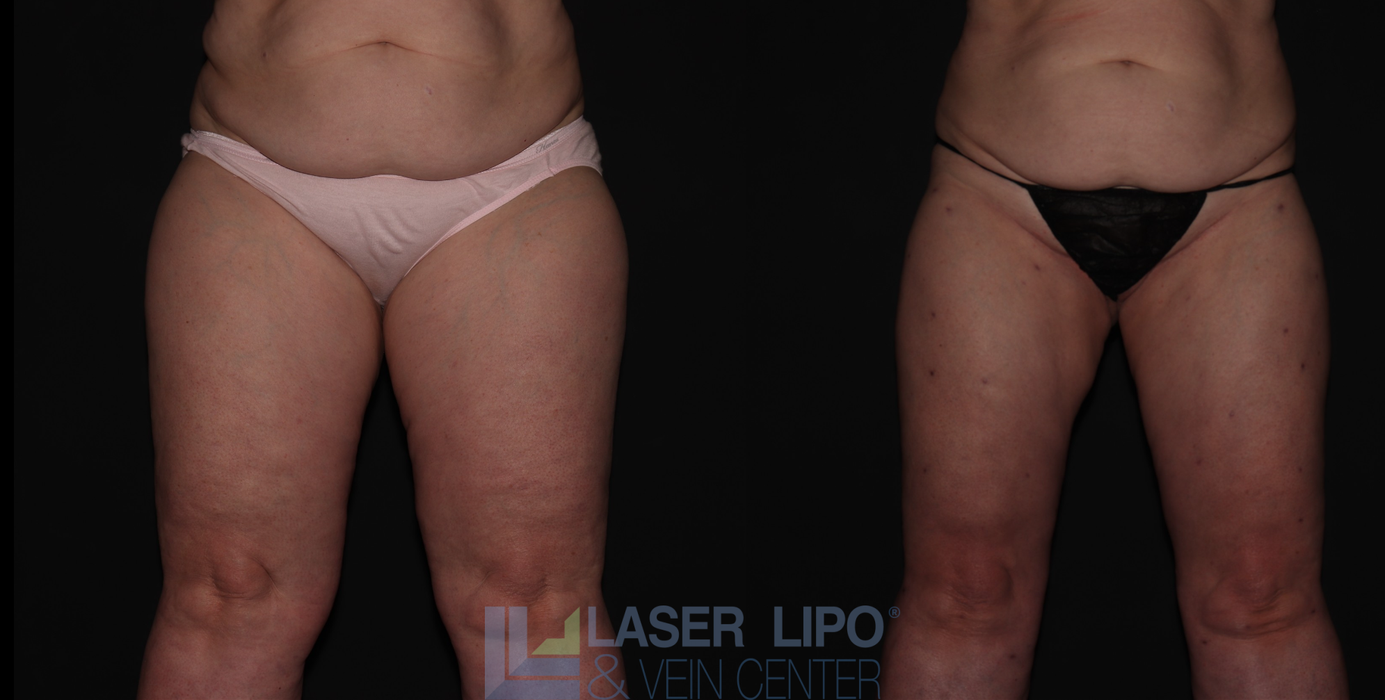 Before and After Image: Stage 2 – Thighs - front