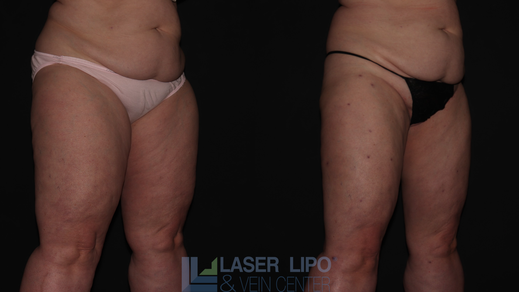 Before and After Image: Stage 2 – Thighs - right-front-oblique