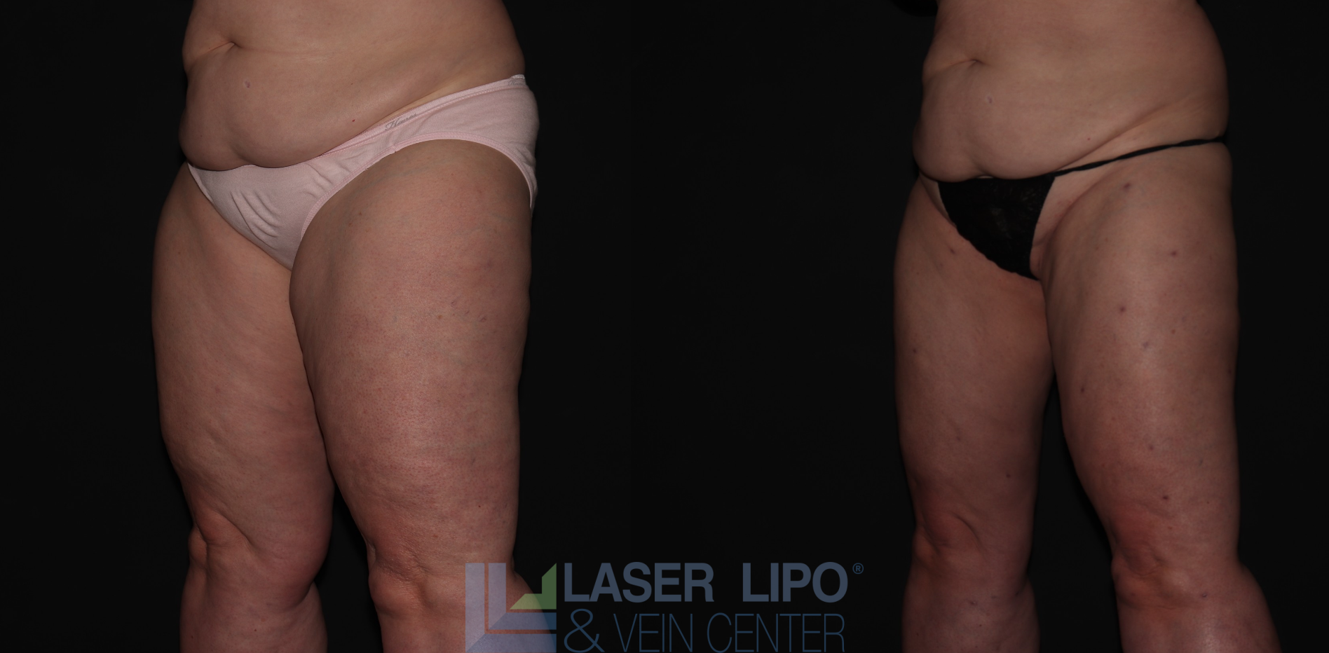 Before and After Image: Stage 2 – Thighs - left-front-oblique