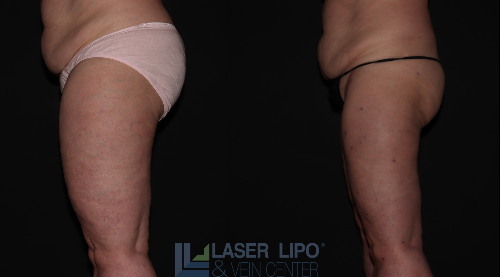 Before and After Image: Stage 2 – Thighs - left-side