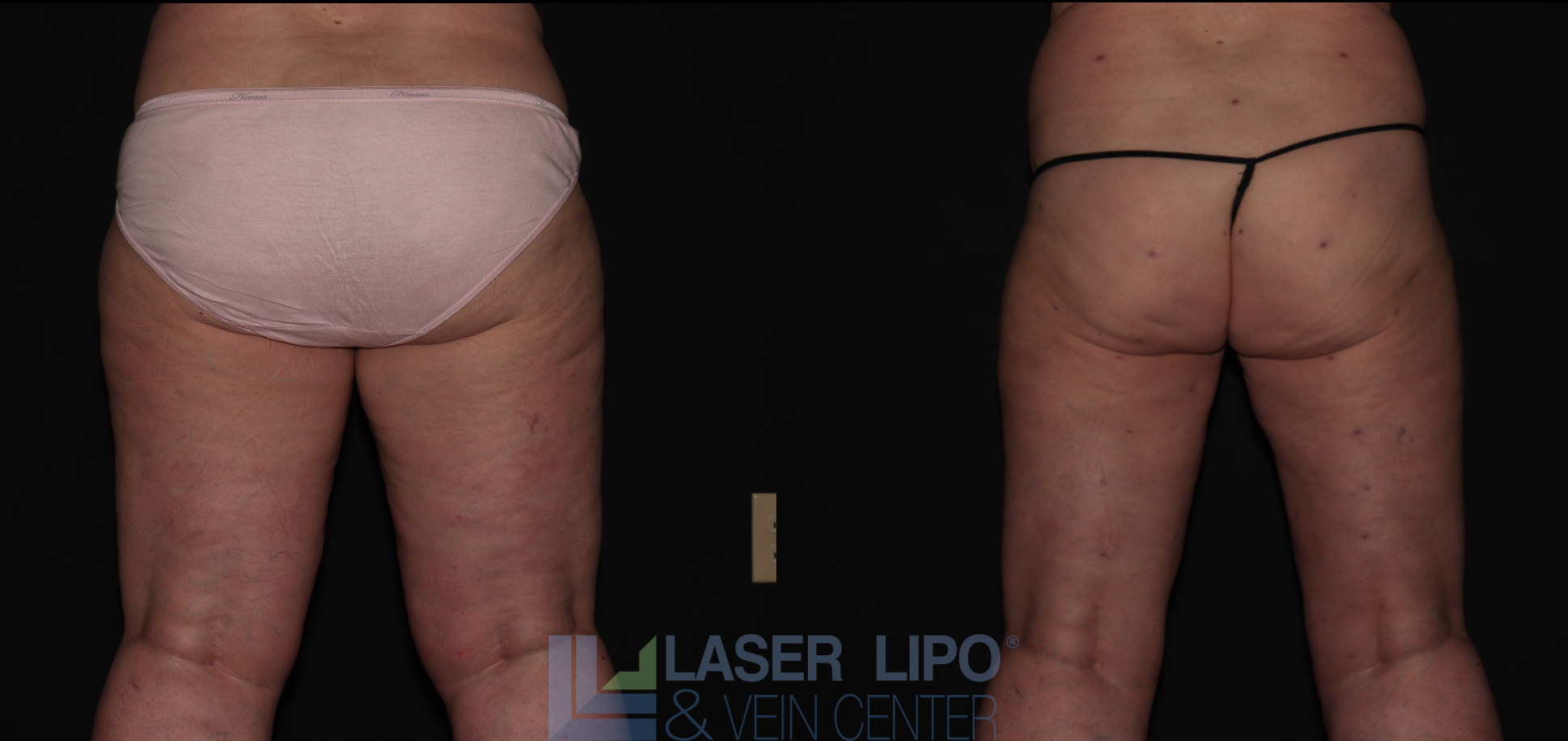 Before and After Image: Stage 2 – Thighs - back
