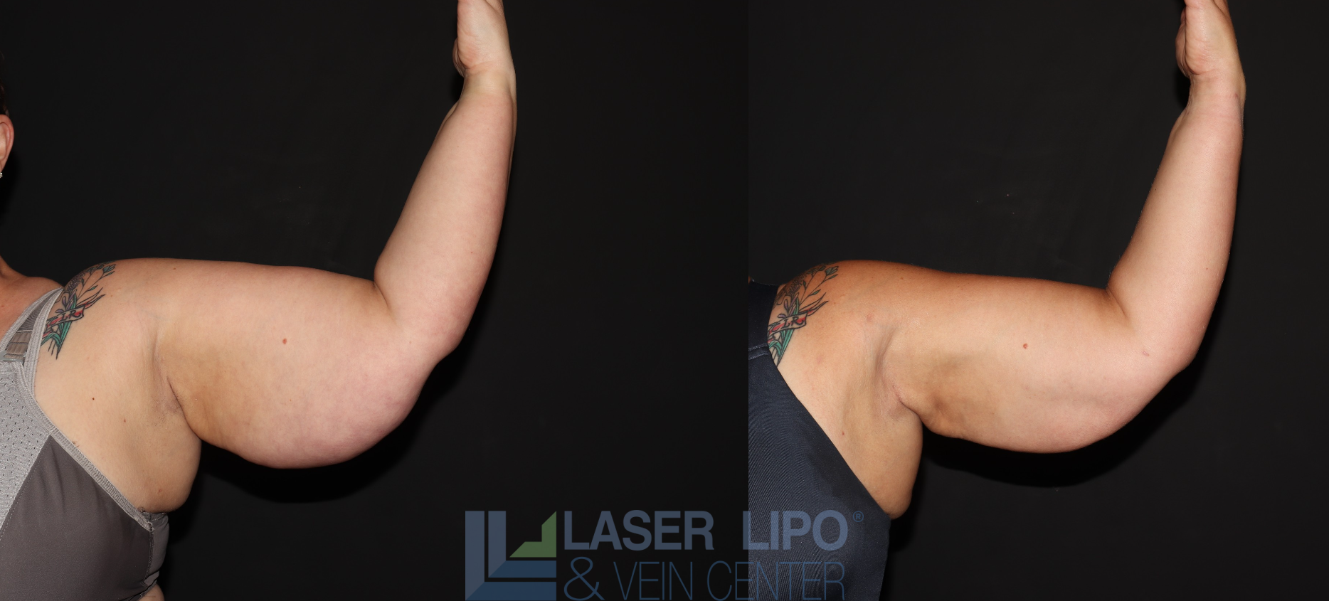 Before and After Image: Stage 3 – Arms - front