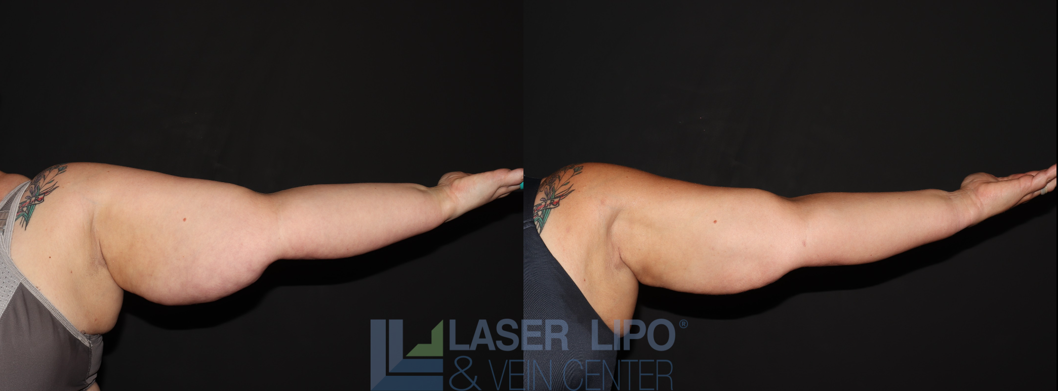 Before and After Image: Stage 3 – Arms - front