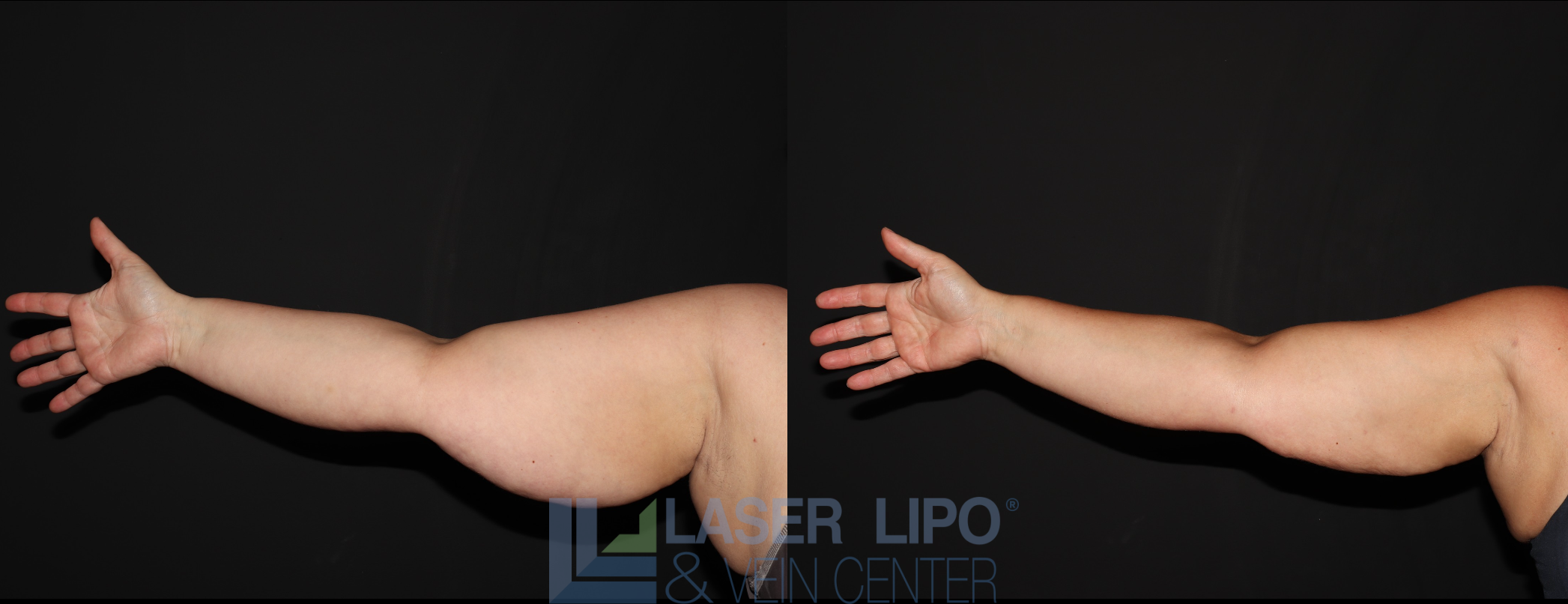 Before and After Image: Stage 3 – Arms - front