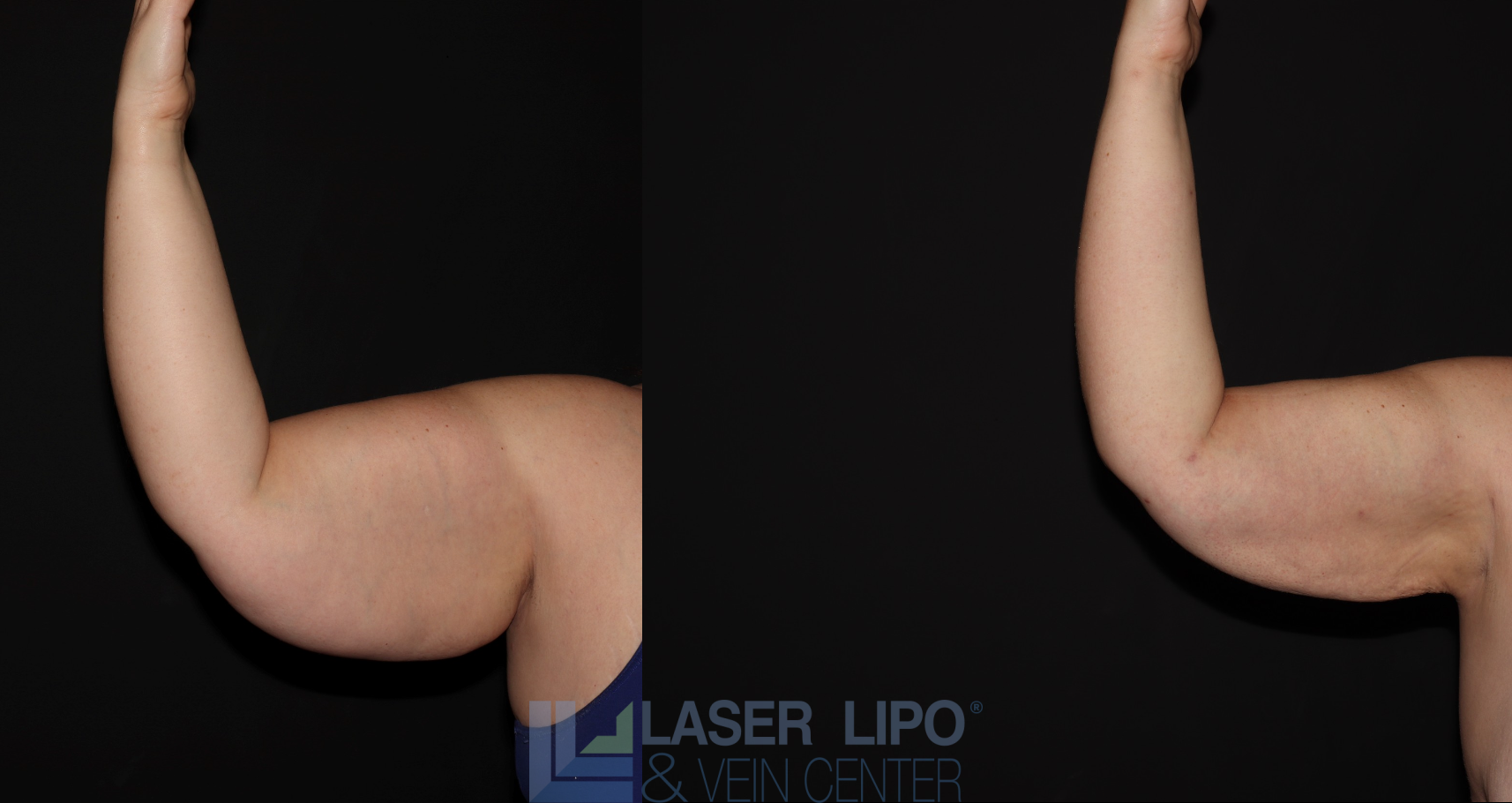 Before and After Image: Stage 3 – Arms - front