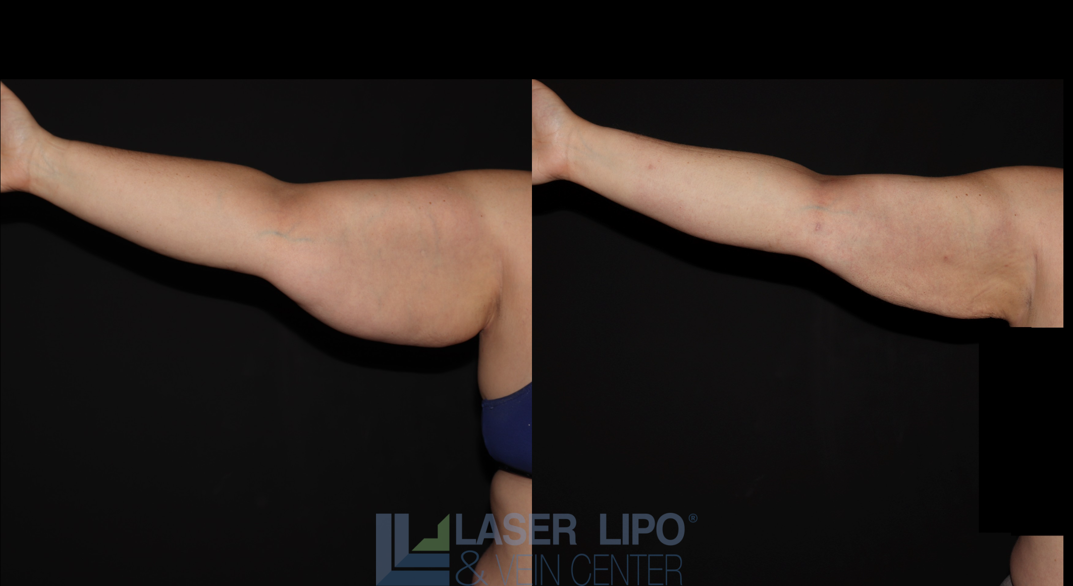 Before and After Image: Stage 3 – Arms - front