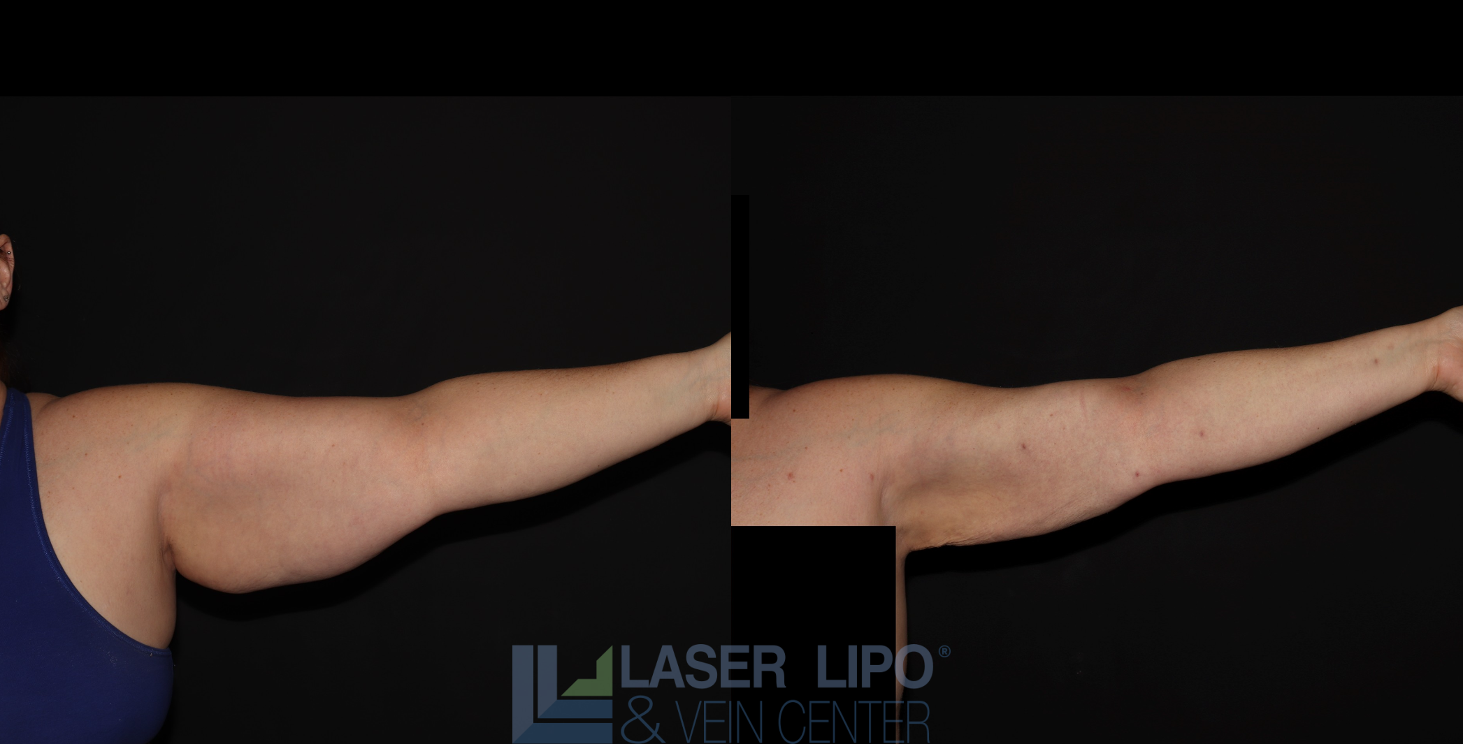 Before and After Image: Stage 3 – Arms - front