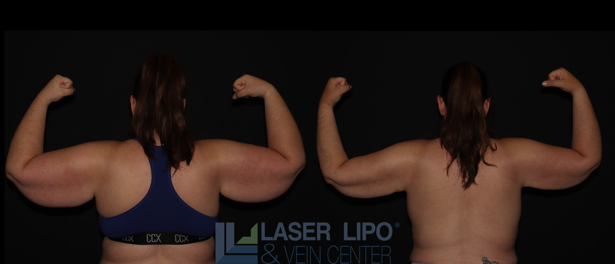 Before and After Image: Stage 3 – Arms - back