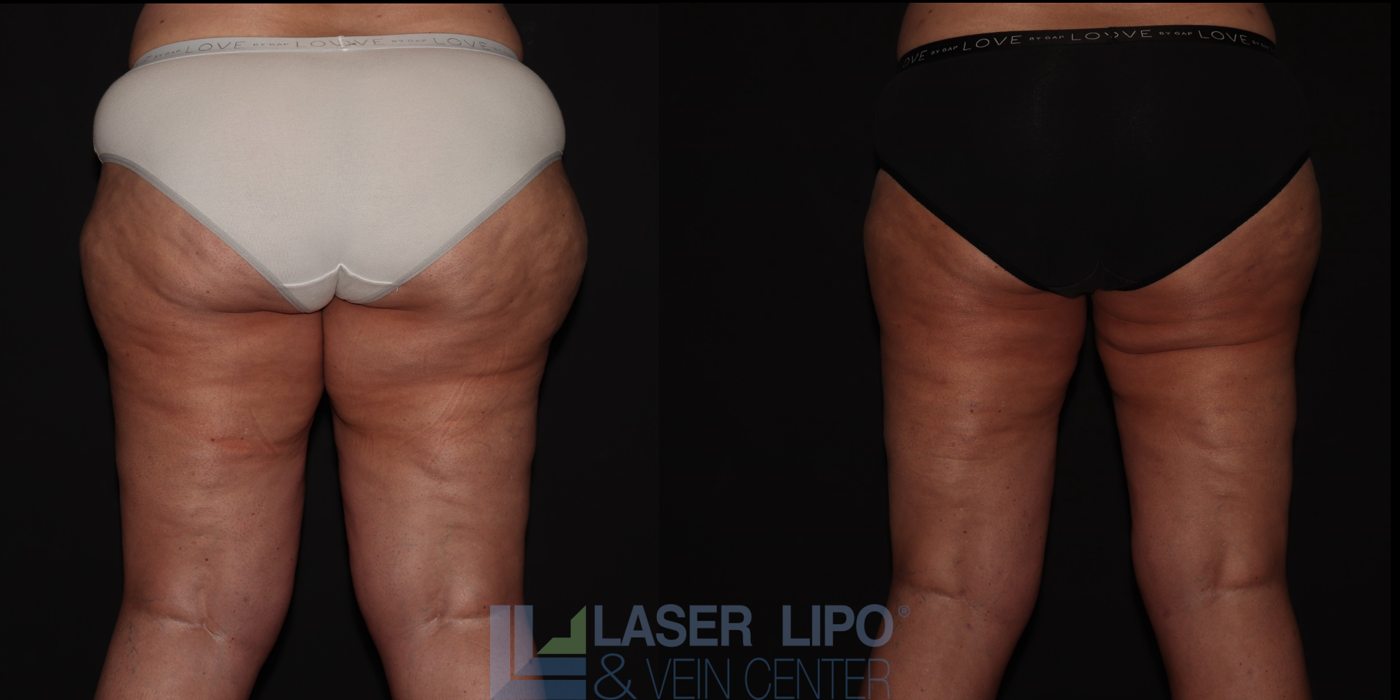 Before and After Image: Stage 3 – Buttocks-Thighs - back