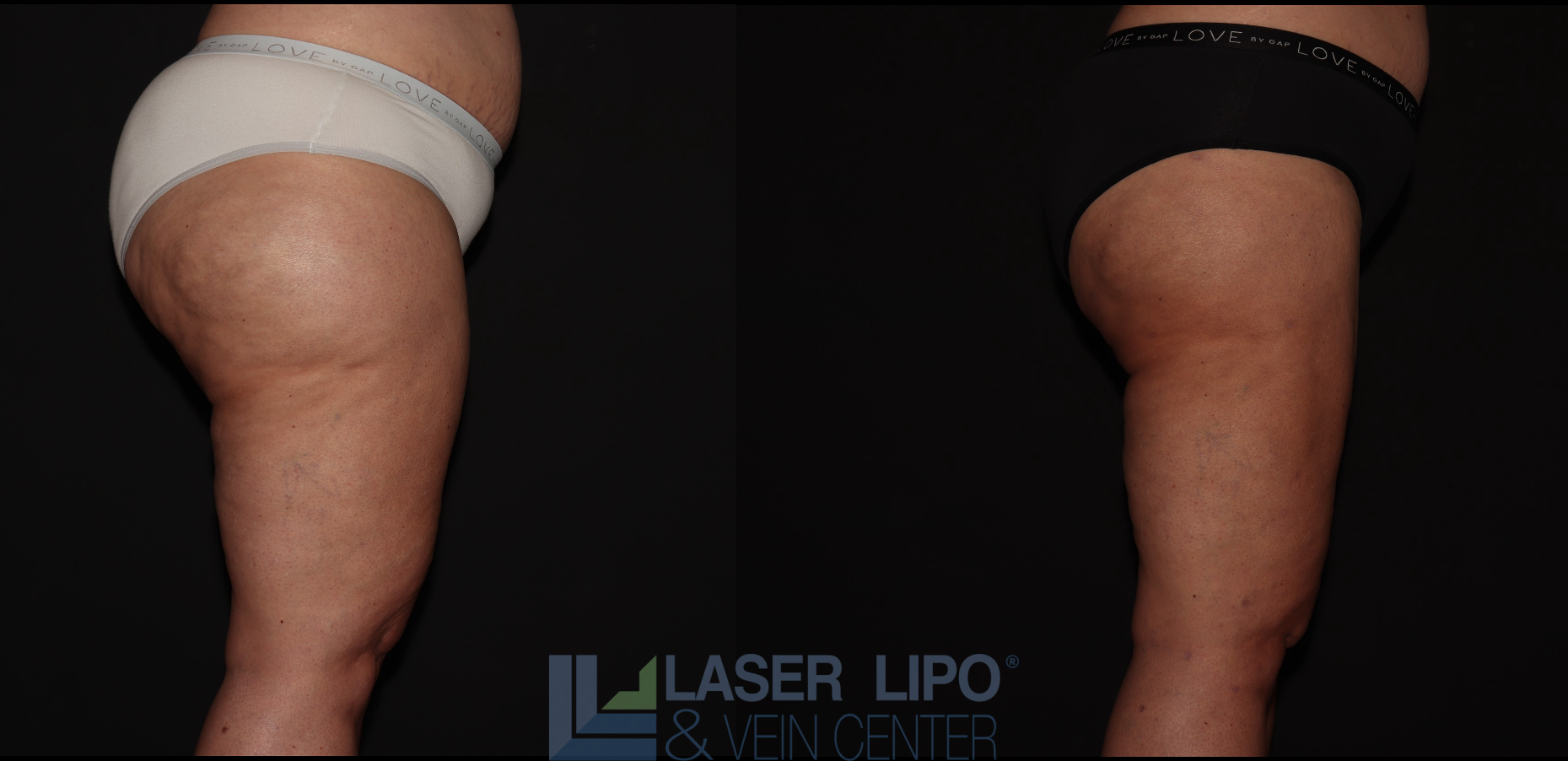 Before and After Image: Stage 3 – Buttocks-Thighs - right-side