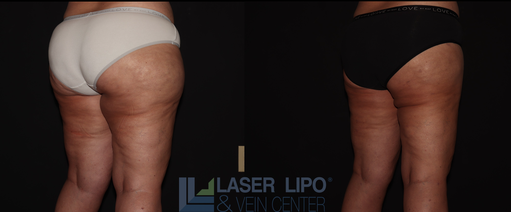 Before and After Image: Stage 3 – Buttocks-Thighs - right-back-oblique