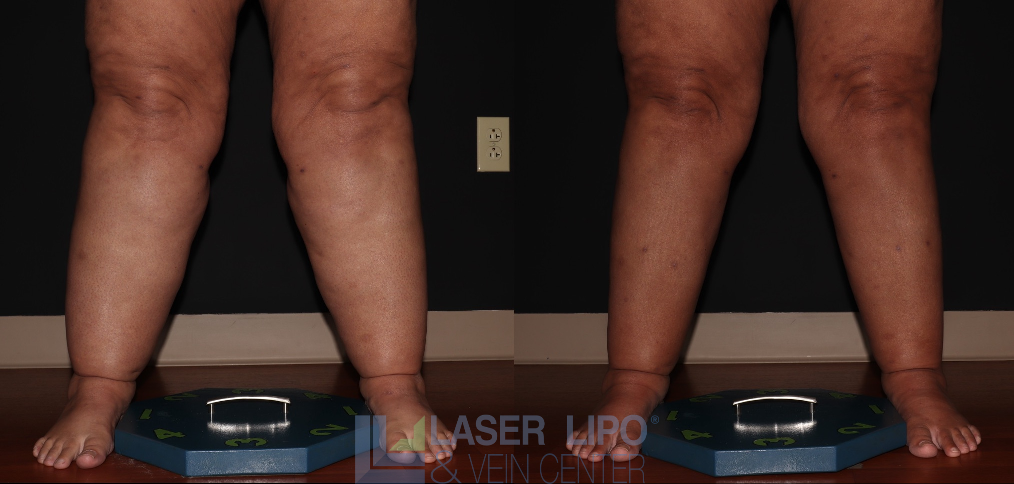 Before and After Image: Stage 3 – Calves-Ankles - front