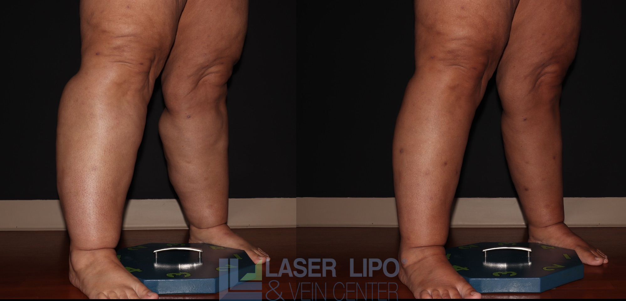 Before and After Image: Stage 3 – Calves-Ankles - right-front-oblique