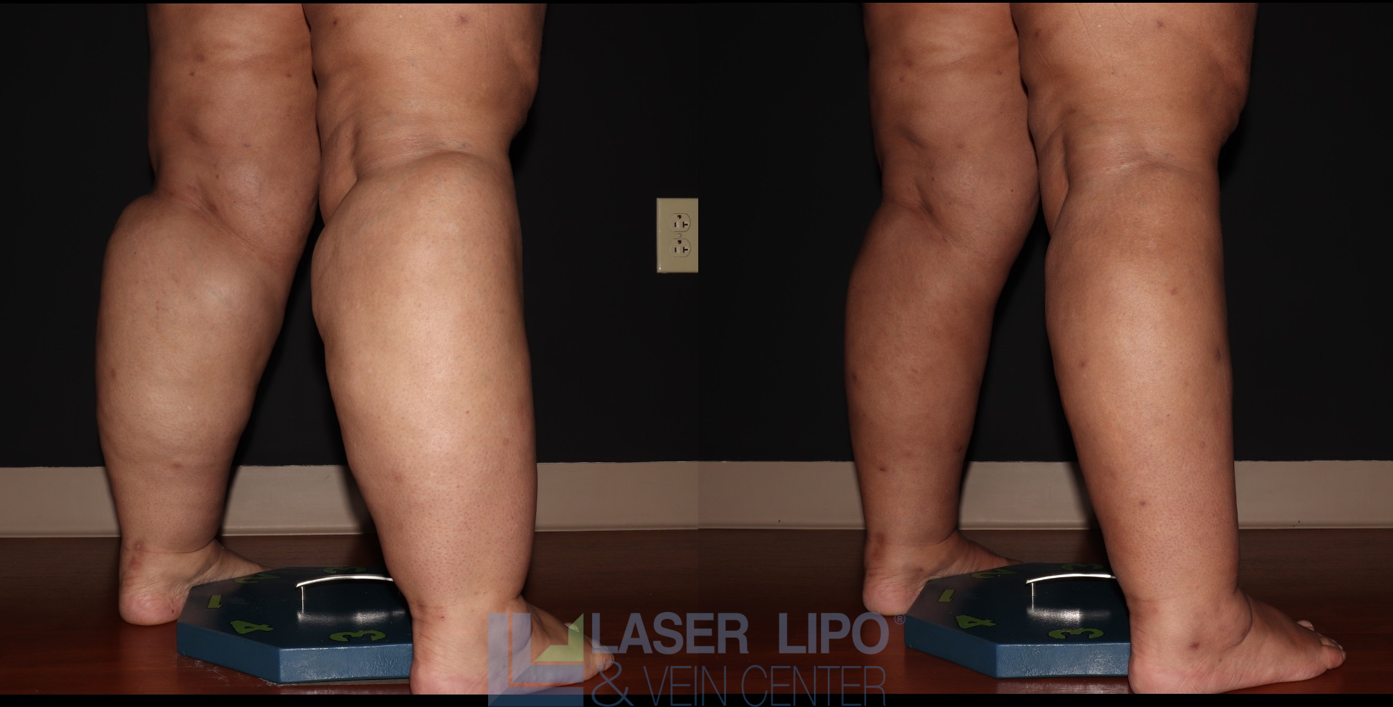 Before and After Image: Stage 3 – Calves-Ankles - right-back-oblique