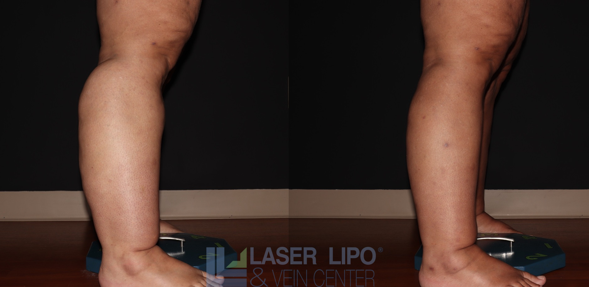 Before and After Image: Stage 3 – Calves-Ankles - right-side