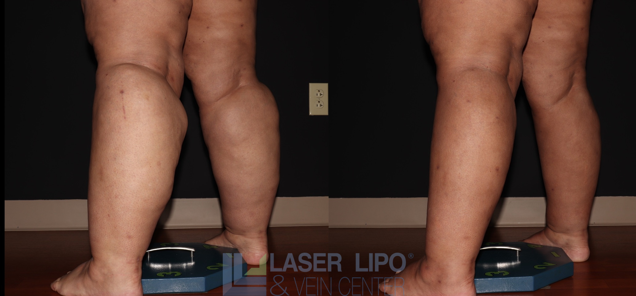 Before and After Image: Stage 3 – Calves-Ankles - left-back-oblique