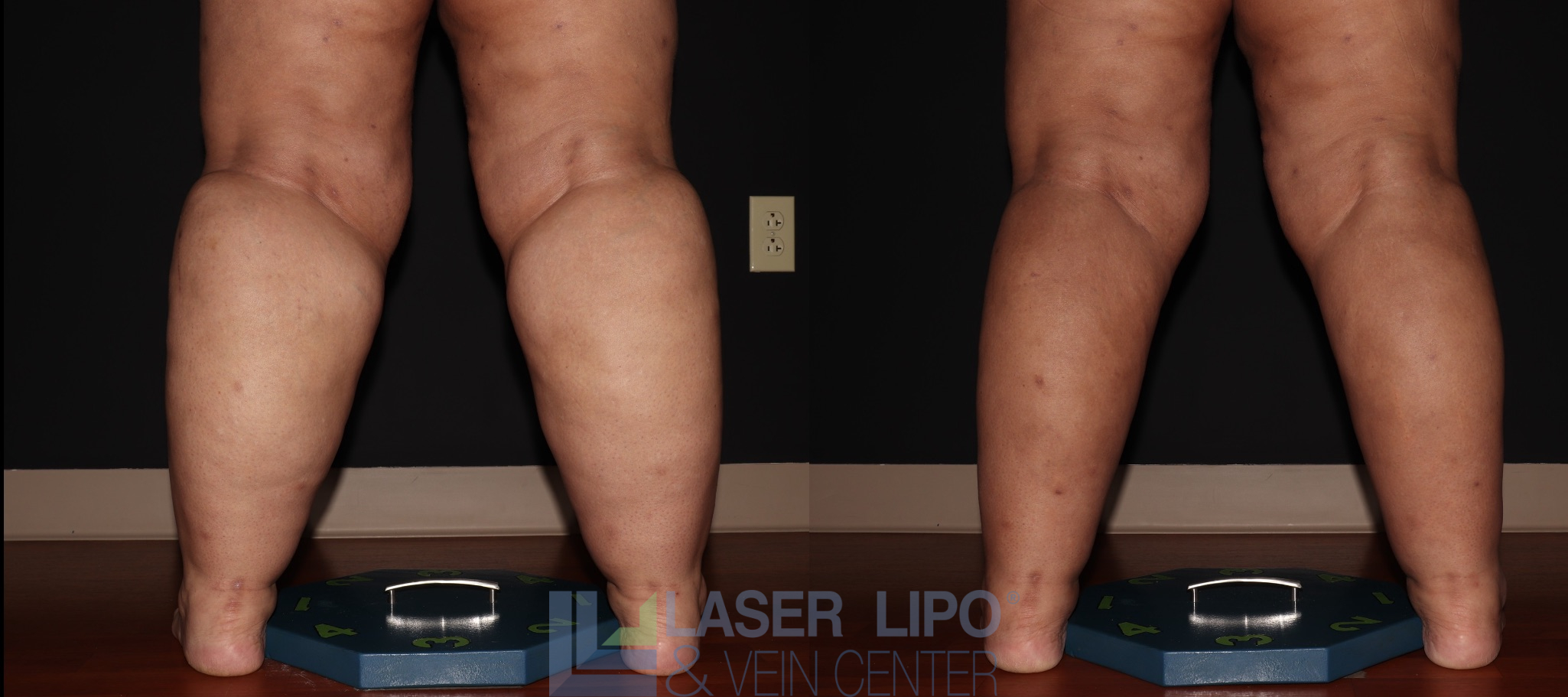 Before and After Image: Stage 3 – Calves-Ankles - back