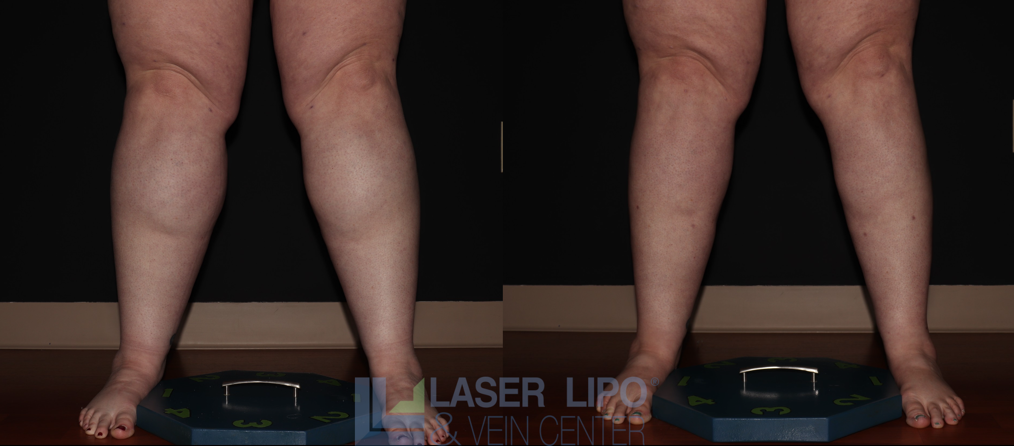 Before and After Image: Stage 3 – Calves - front