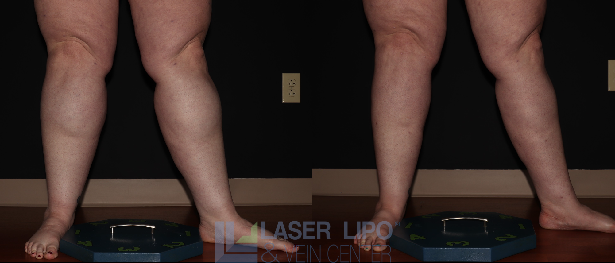 Before and After Image: Stage 3 – Calves - right-front-oblique