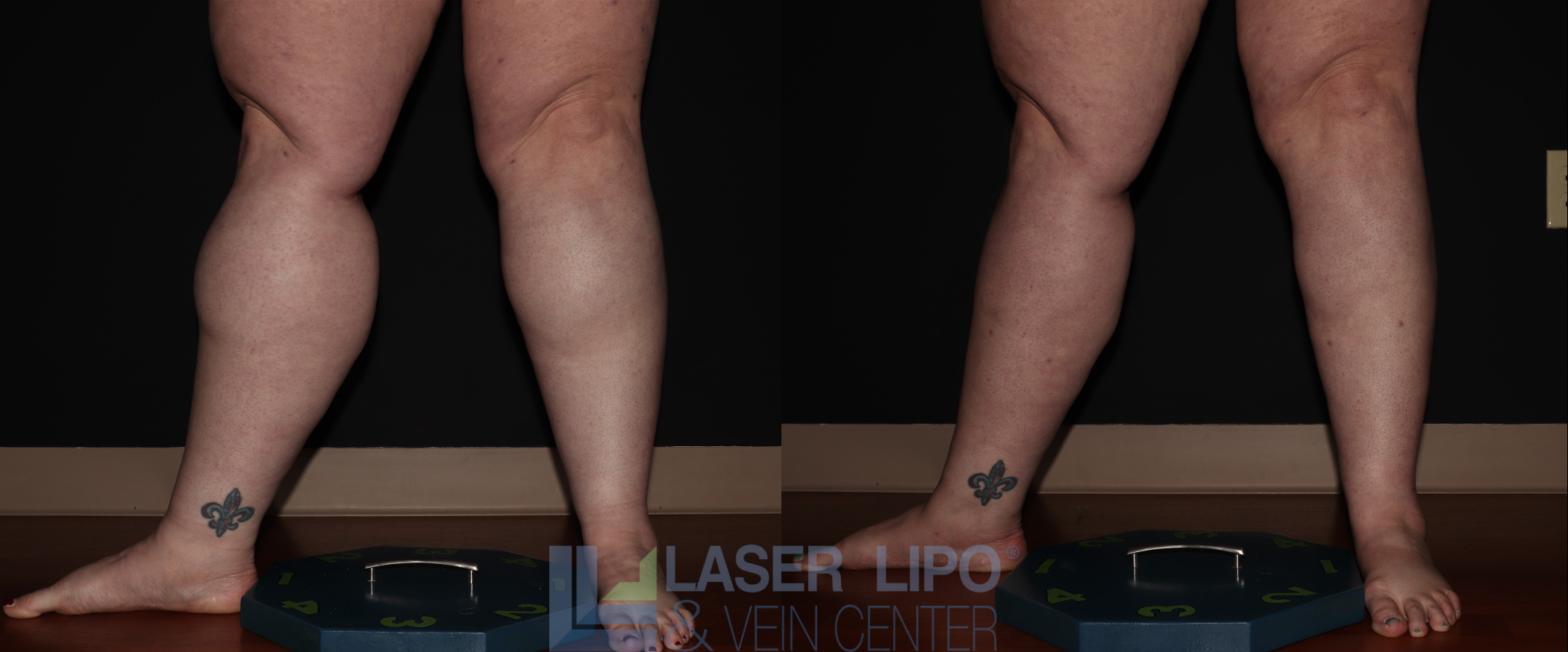 Before and After Image: Stage 3 – Calves - left-front-oblique