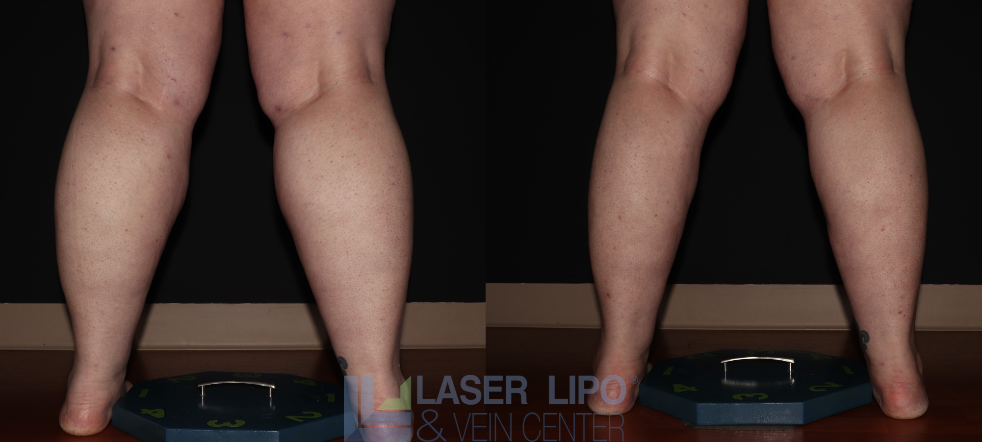 Before and After Image: Stage 3 – Calves - back