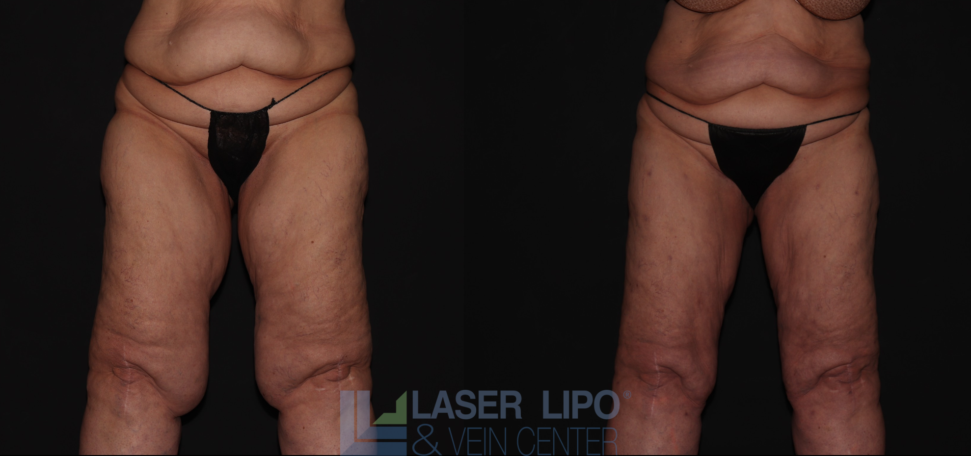 Before and After Image: Stage 3 – Thighs - front
